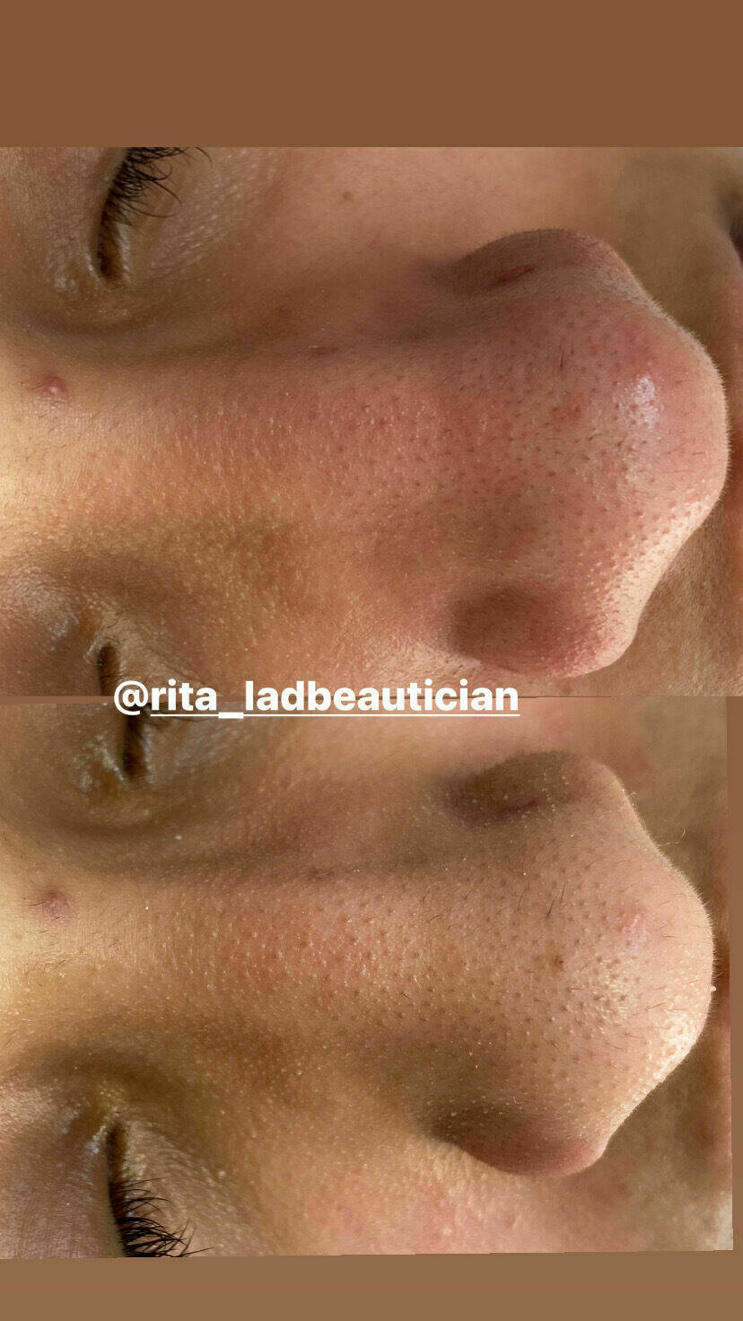 Microdermabrasion facial before and after 
