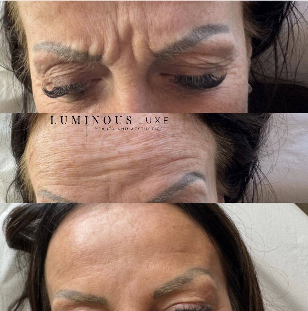 Forehead & Static Lines: Visible improvement don’t happen overnight—but with the right approach, smoother skin is possible 😌 