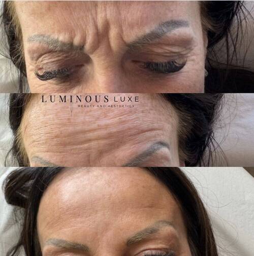 Forehead & Static Lines: Visible improvement don’t happen overnight—but with the right approach, smoother skin is possible 😌 