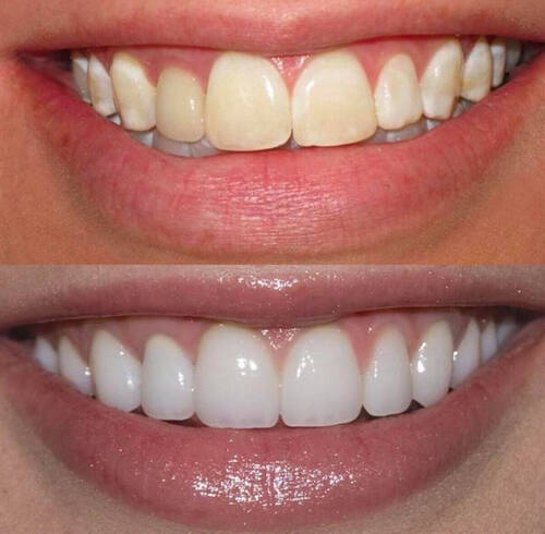 Naturawhite Laser Teeth Whitening