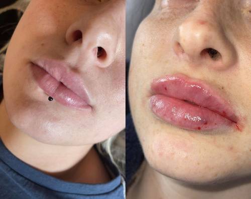 1.1ml Lip Enhancement 