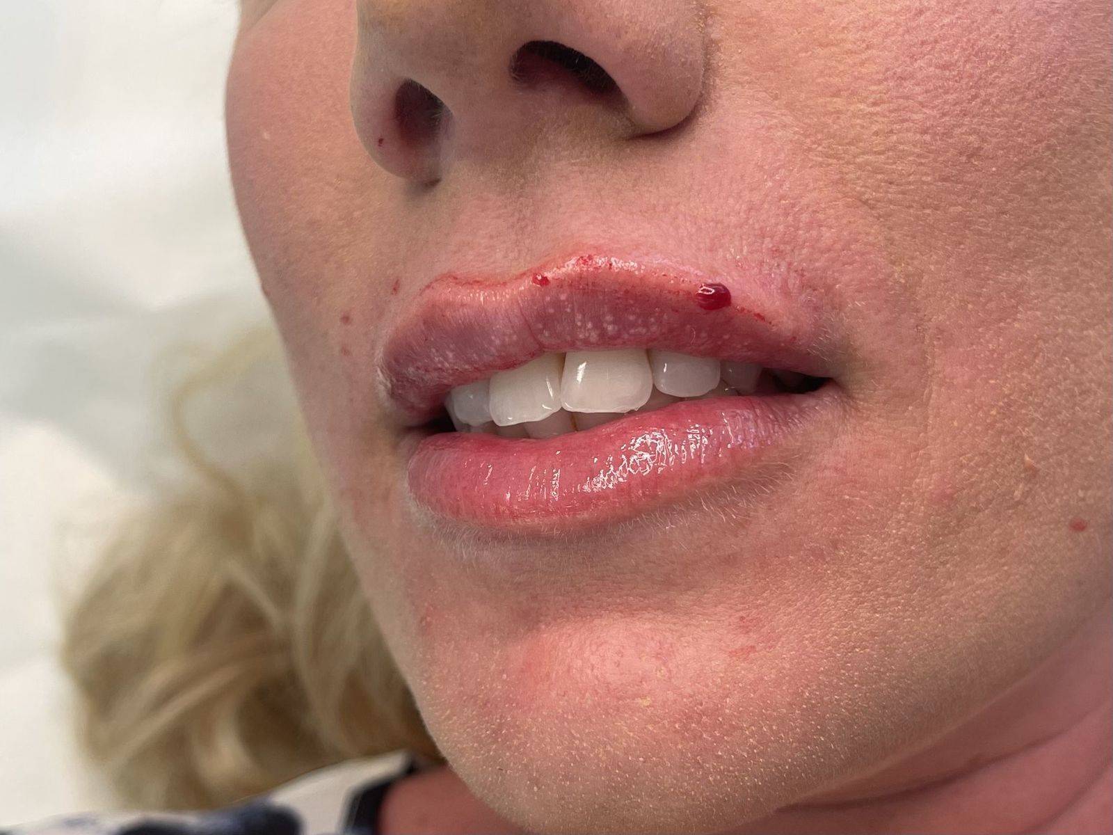 1.1ml Lip Enhancement 