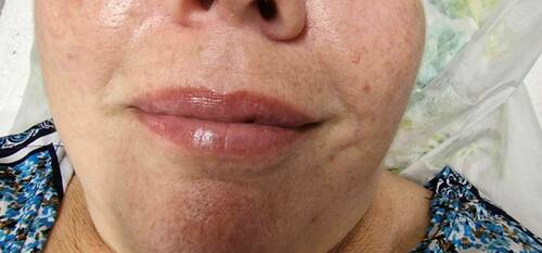 HIDRATACION PROFUNDA DERMA-PEN