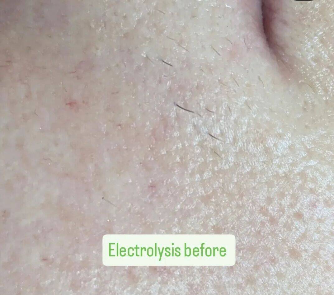 Electrolysis - Top lip - Before