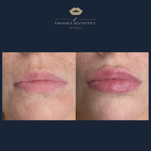 Lip Augmentation 1ml