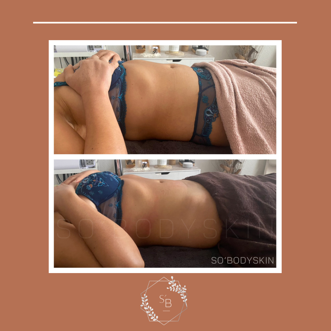Drainage Lymphatique Brésilien - Résultat en 1 séance