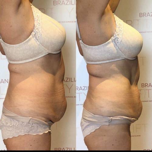 One session of Tummy Sculpt Ultimate 