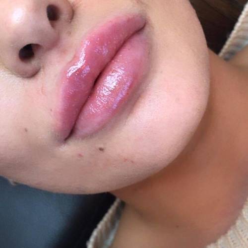 Lip Fillers Before and After