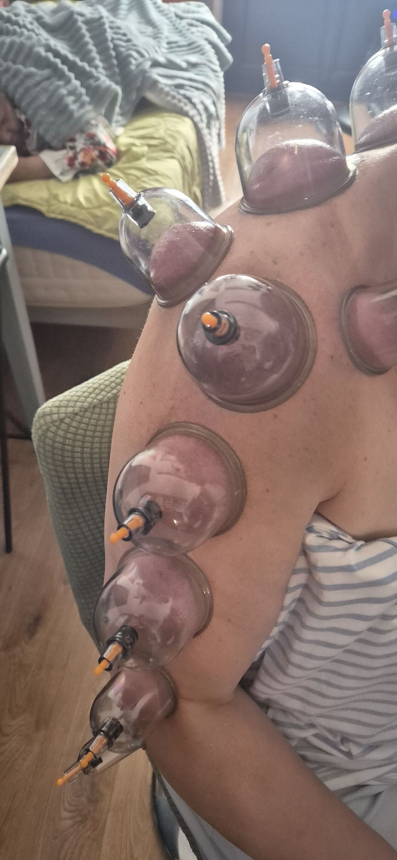 Tendinite du bras et douleur a l'épaule . Pose fixe de 20 minutes . 
Soulagement Consultant Immédiat 