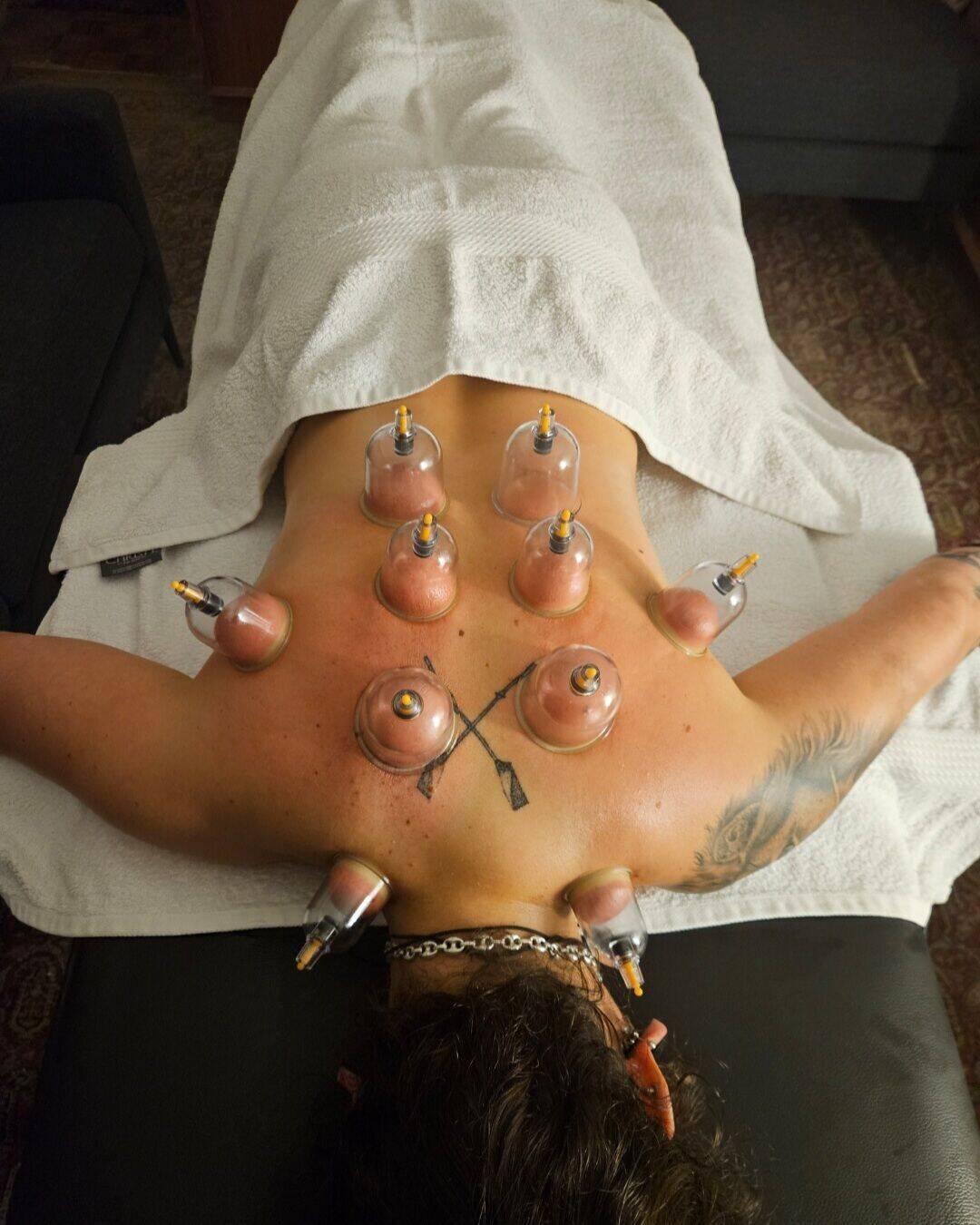 Cupping Therapy 