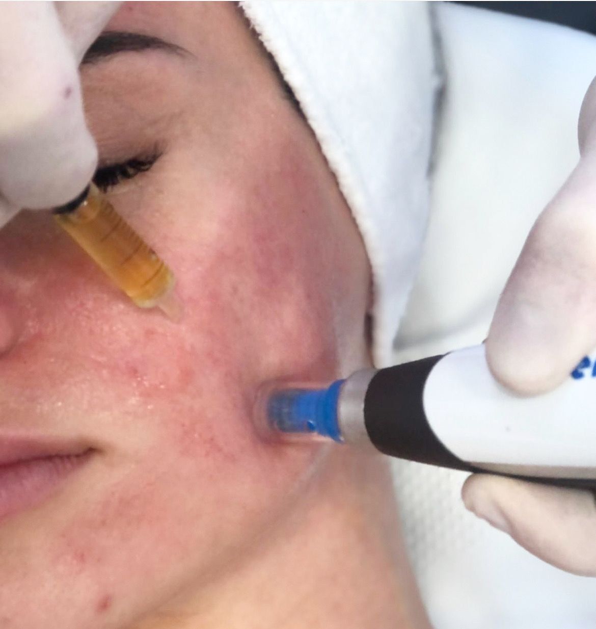 Microneedling 