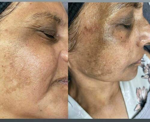 Chemical peel before and after 