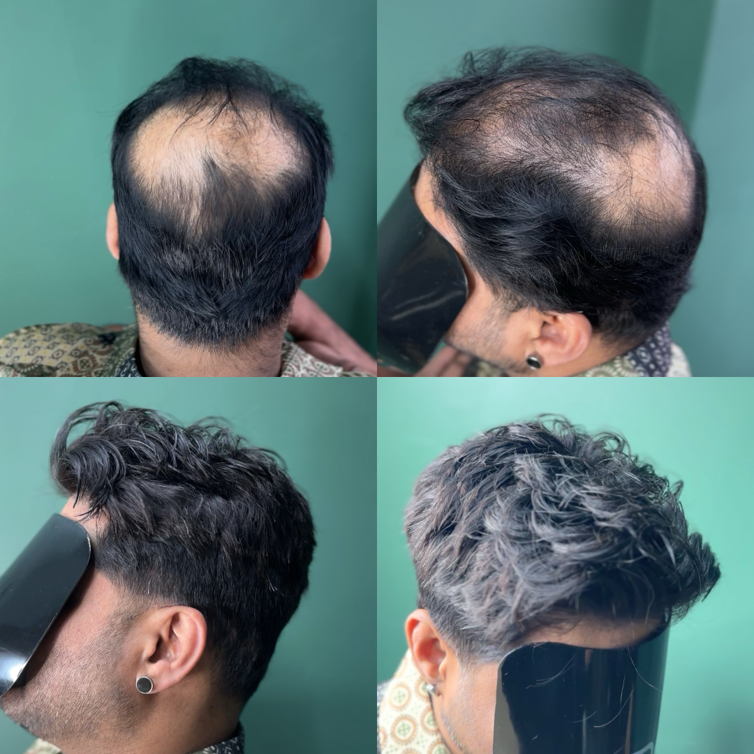 Non-surgical hair system installation by Riz at RYZN Barbers & Grooming, Musselburgh — natural look, seamless blend, and undetectable finish.