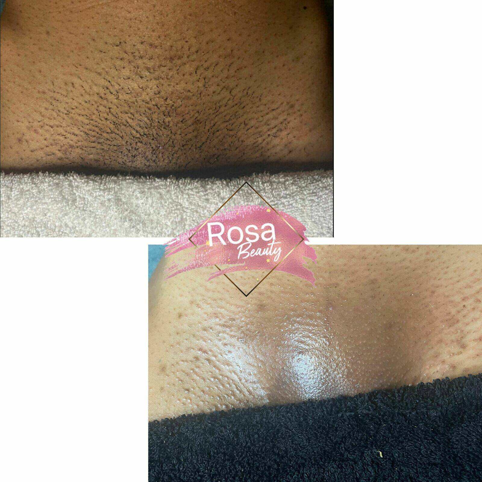 Épilation intégral 