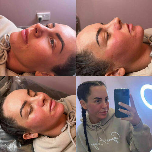 Microneedling and Chemical Peel