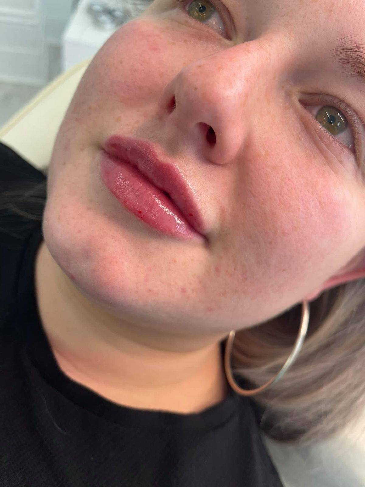 1.1ml Lip Enhancement 