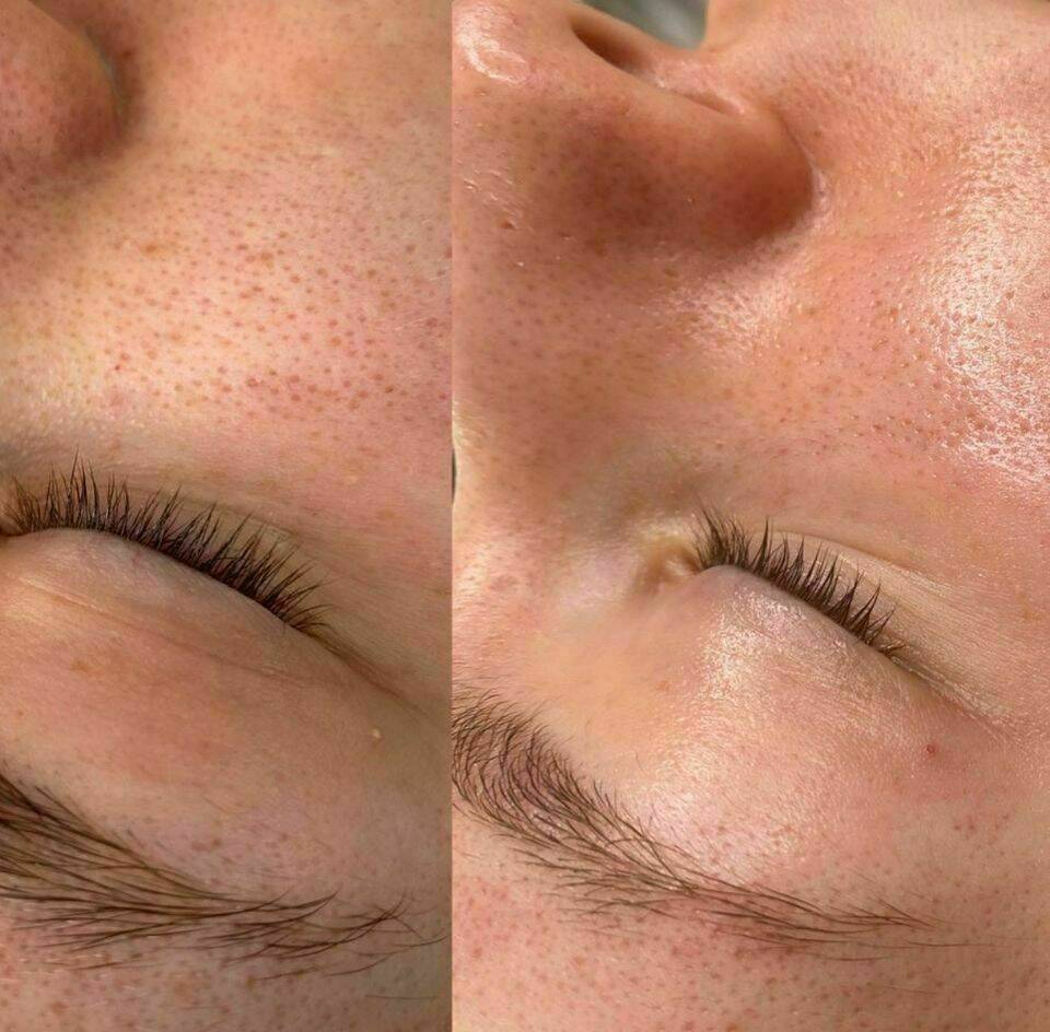 Porenverfeinertes Hautbild 