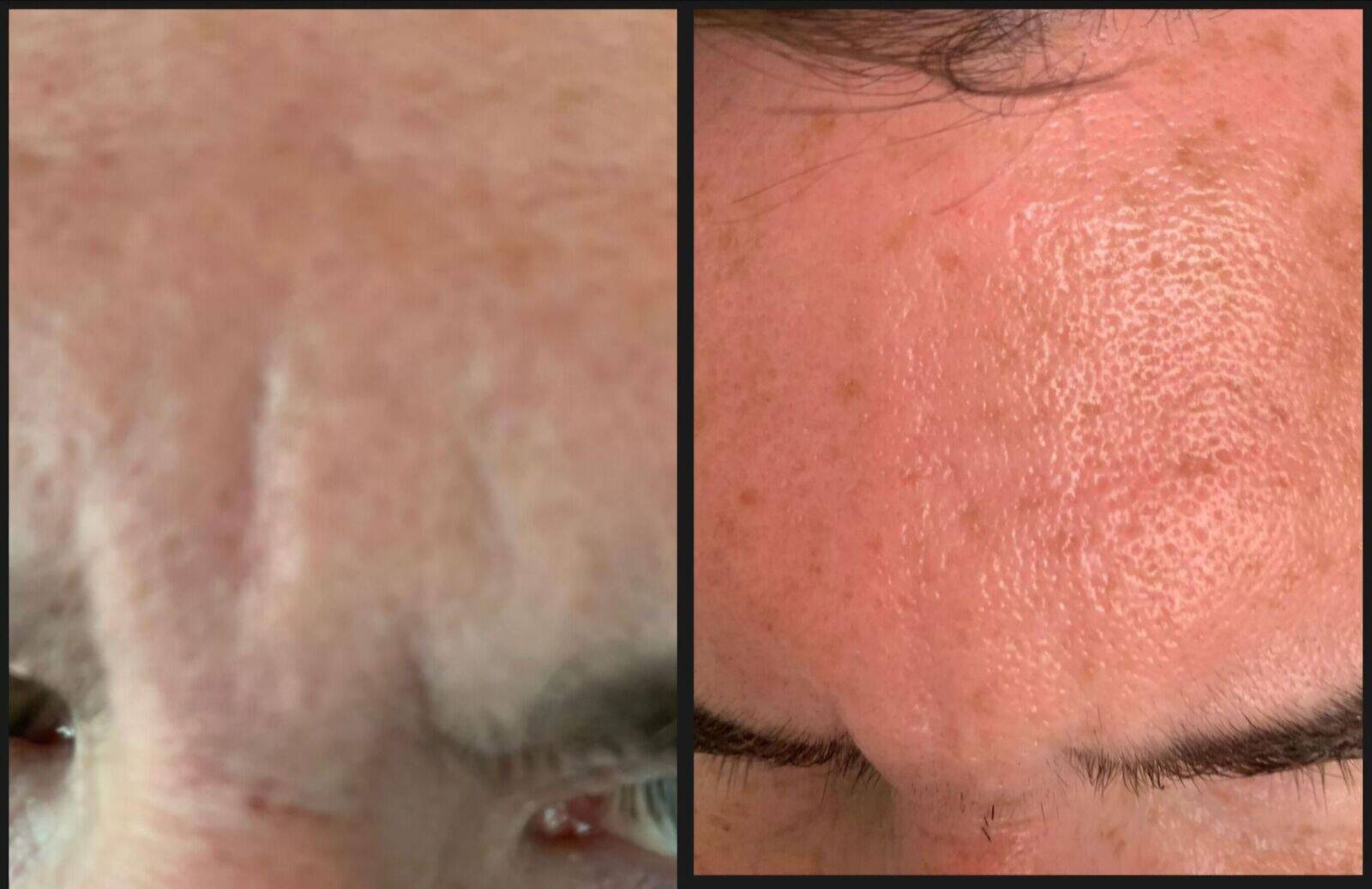 Anti-wrinkle and filler