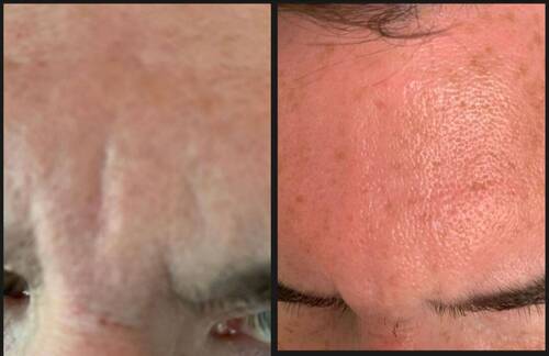 Anti-wrinkle and filler