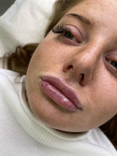 1.1ml Lip Enhancement 