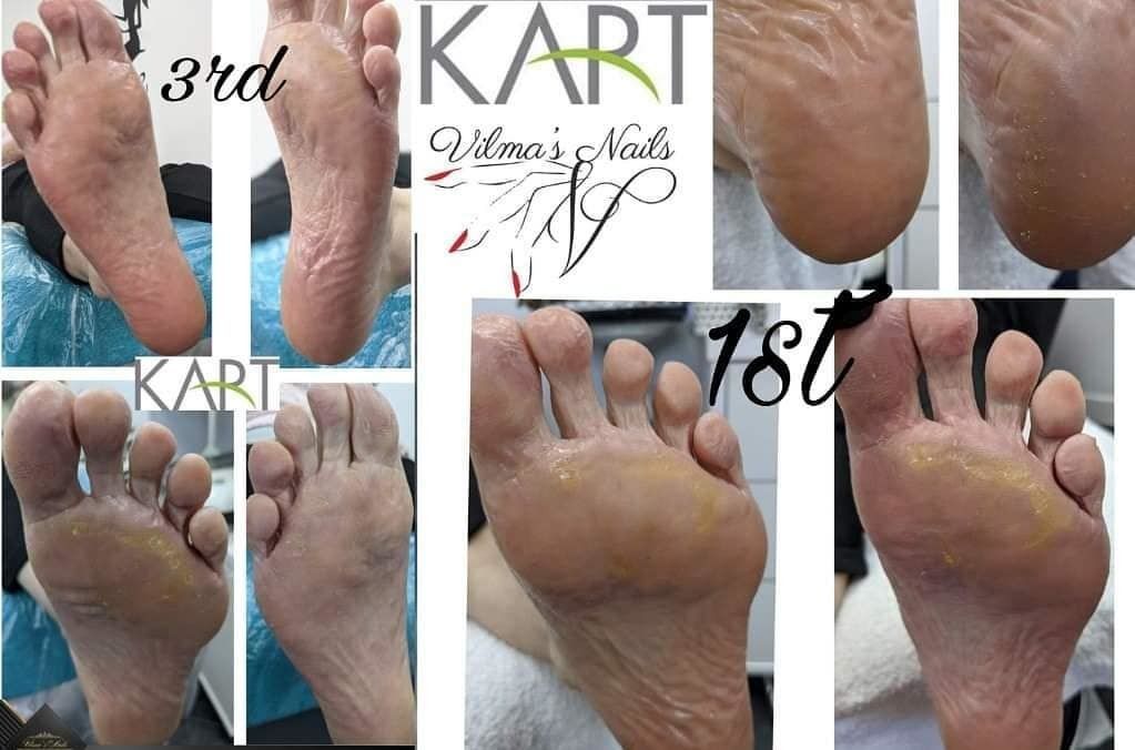 1st and 3rd KART PEDICURE Treatment result.