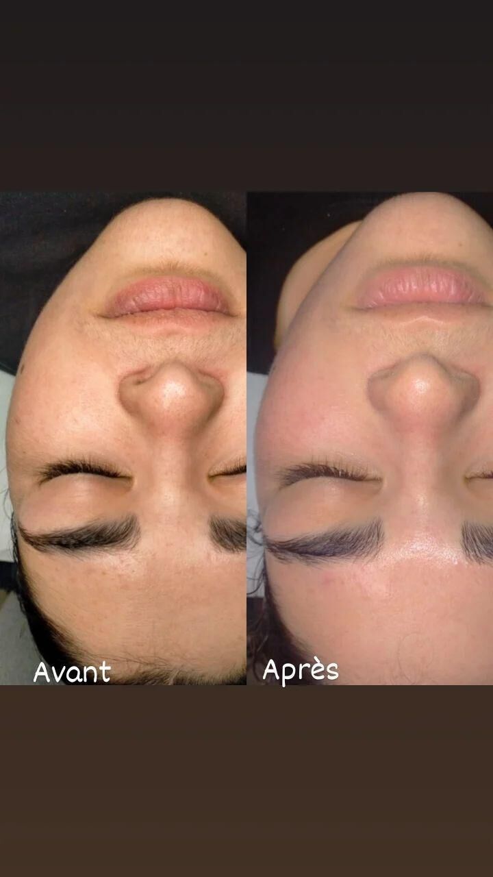 Dermaplaning 