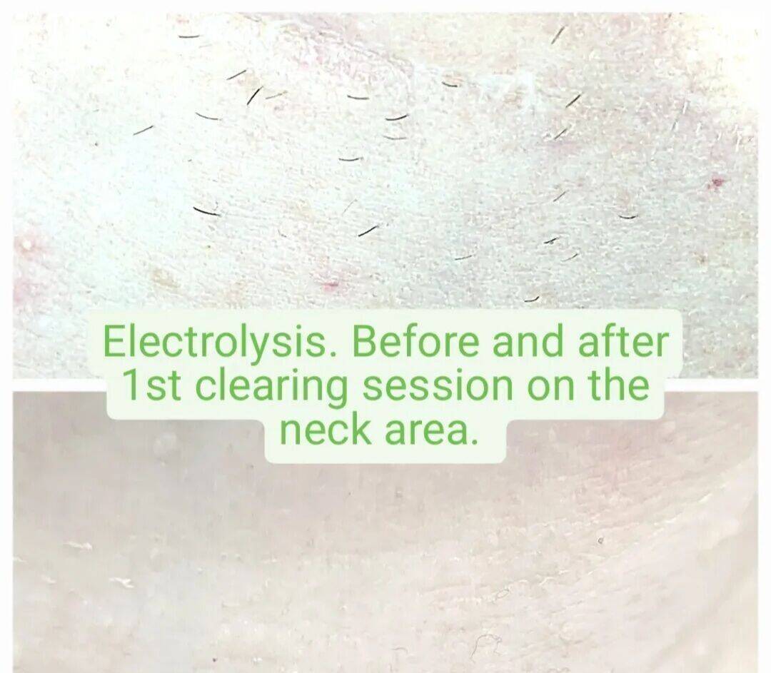 Electrolysis Hair Removal