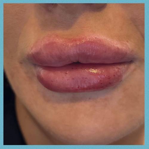 1.1ml Lip Enhancement 