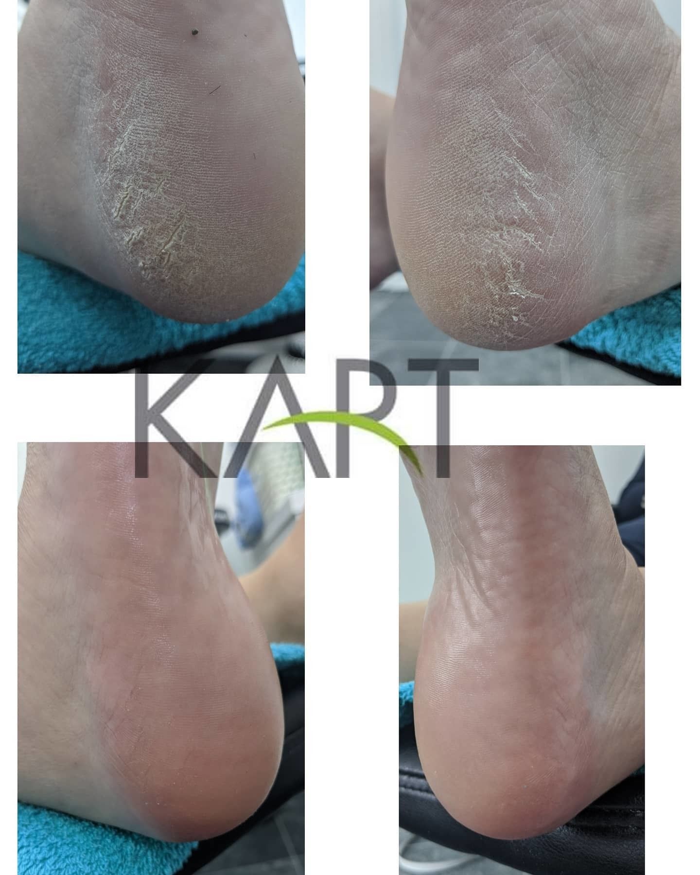 Kart Treatment Pedicure1st one#Kart Scotland#Toes