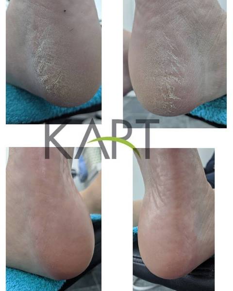 Kart Treatment Pedicure1st one#Kart Scotland#Toes