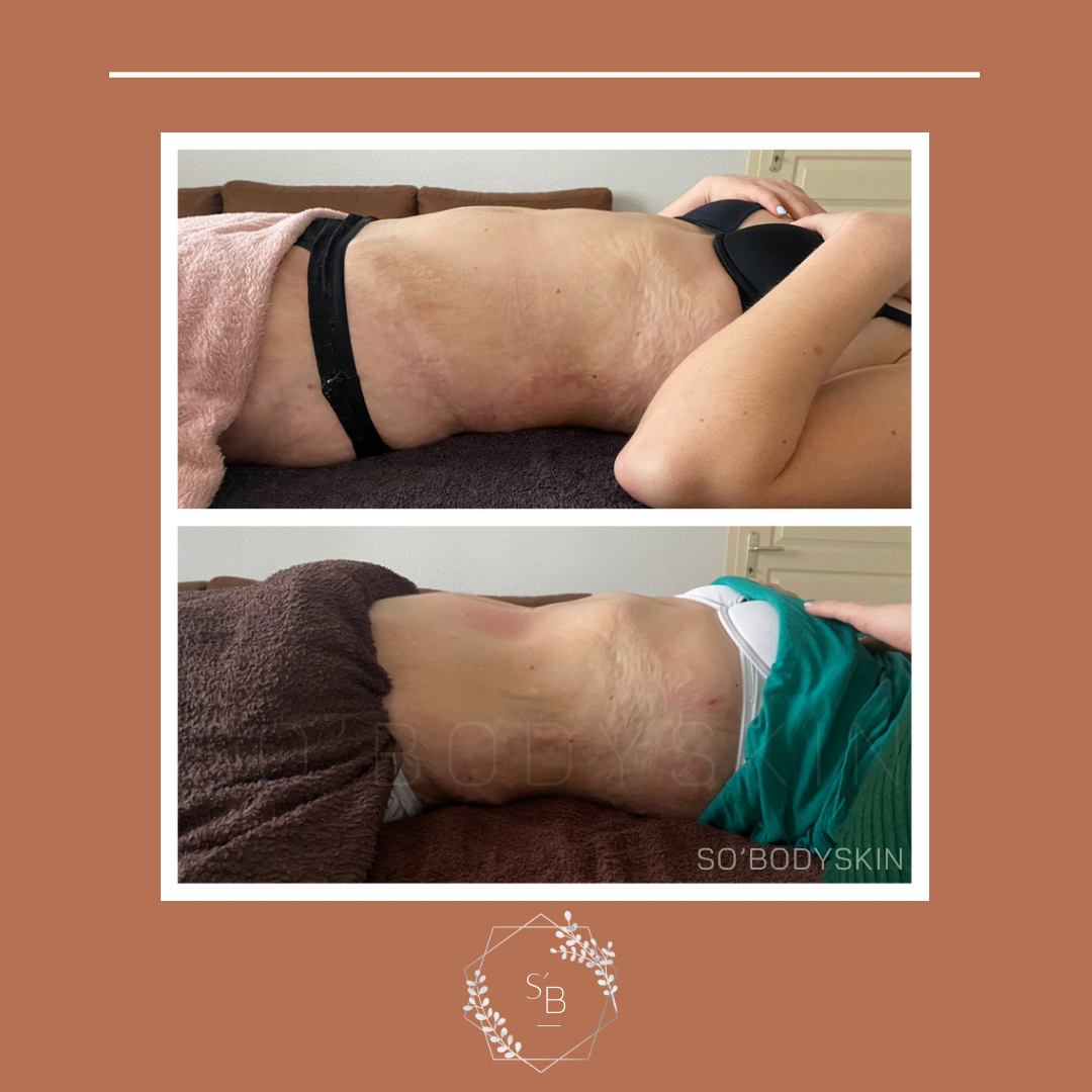Drainage Lymphatique Brésilien - Résultat en 2 séances