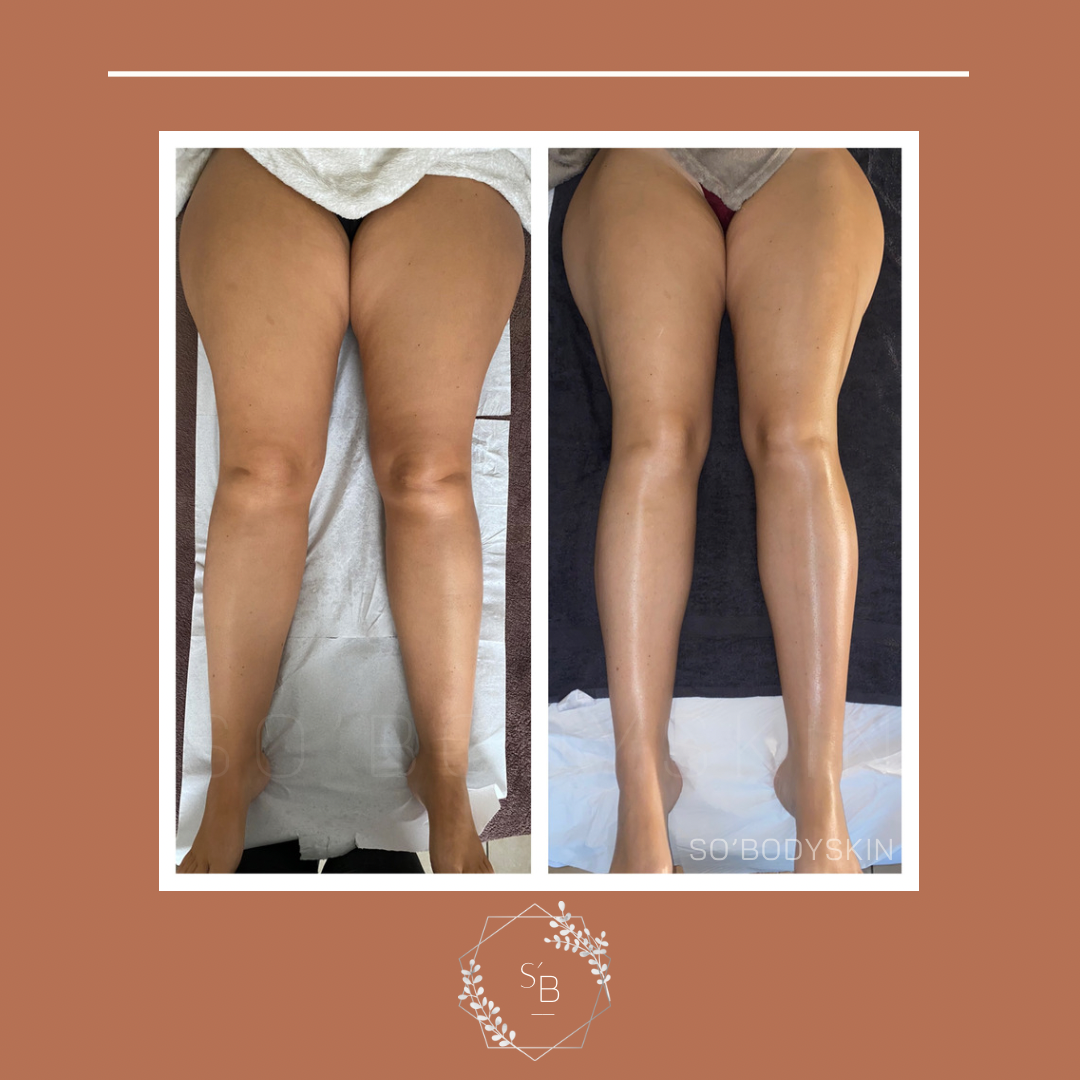Drainage Lymphatique Brésilien - Résultat après la cure de 5 séances
