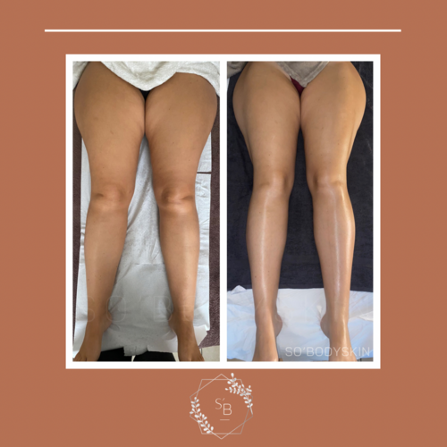 Drainage Lymphatique Brésilien - Résultat après la cure de 5 séances