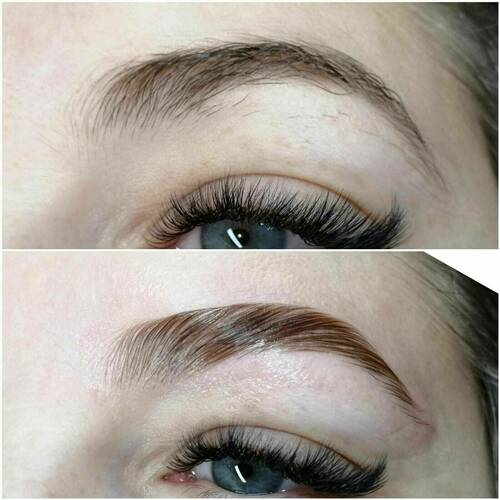 Brow lift