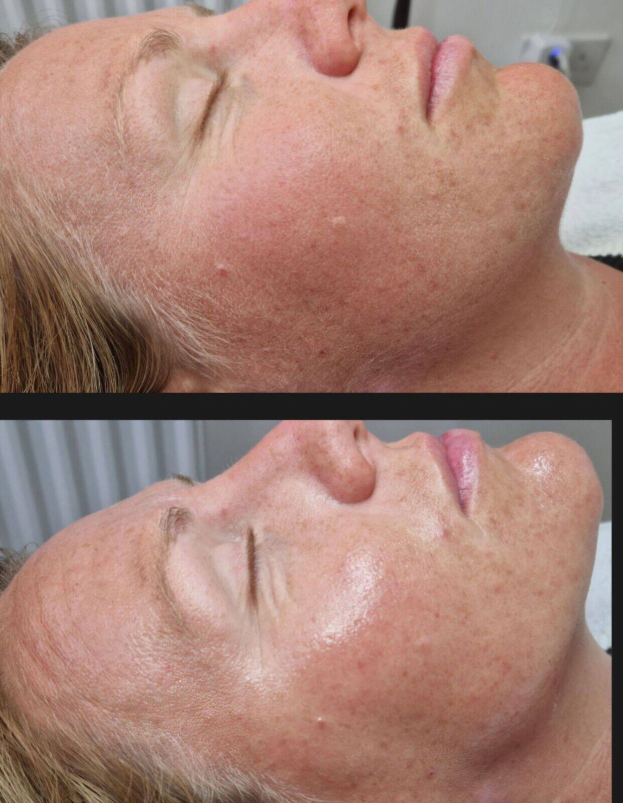 Dermaplane and chemical peel