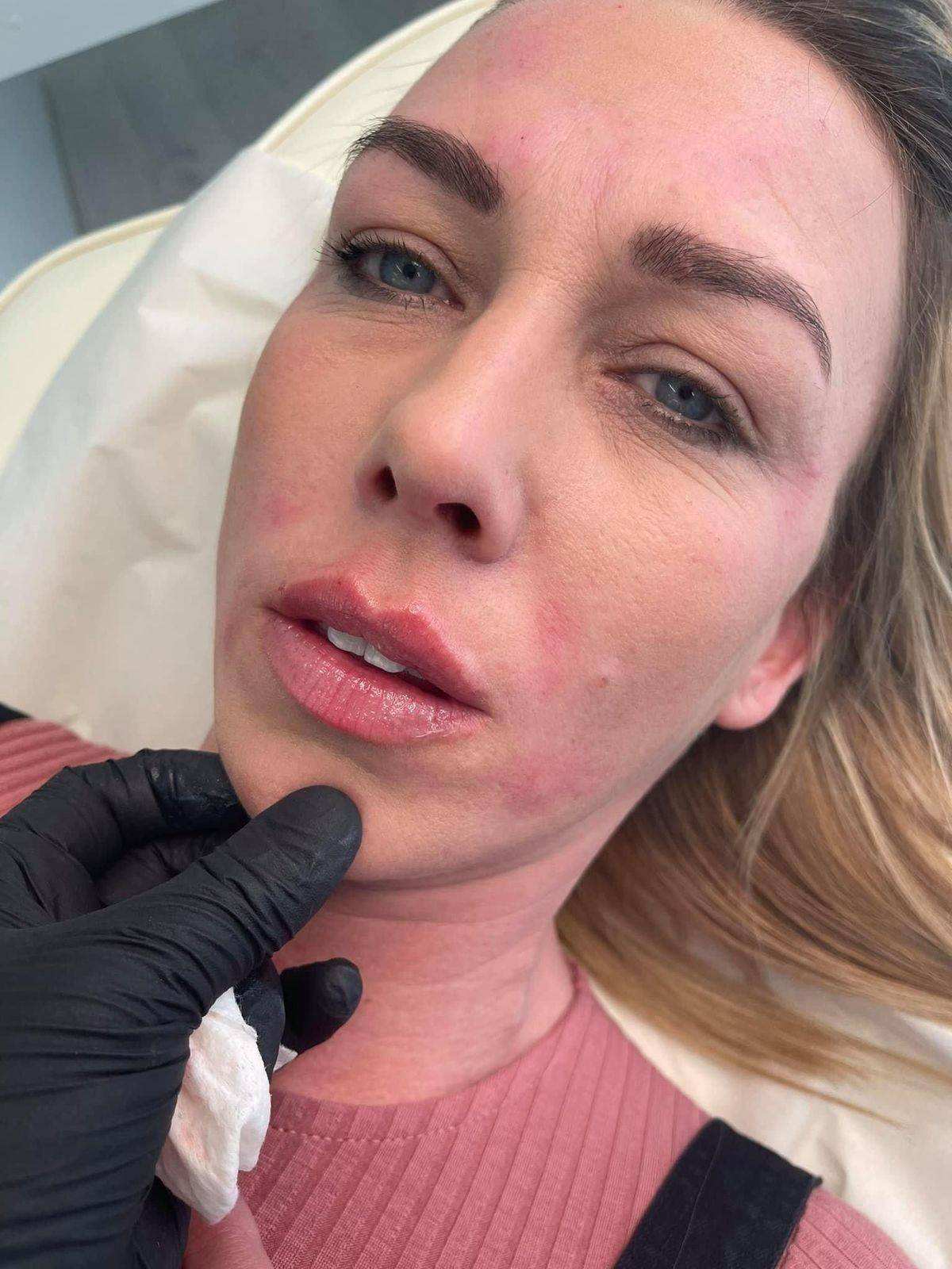 1.1ml Lip Enhancement 