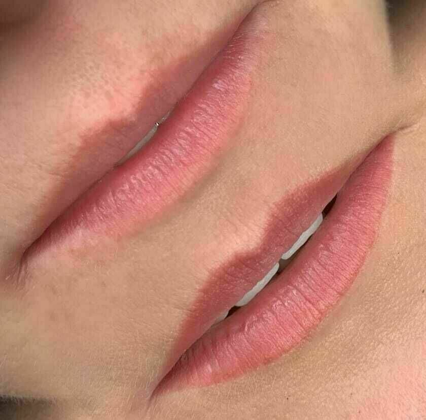 1. Bild vor der Behandlung 2. Bild abgeheilte Lippen vor der Nachbehandlung 