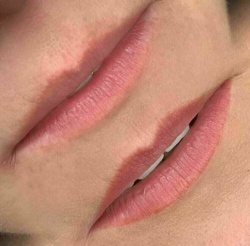 1. Bild vor der Behandlung 2. Bild abgeheilte Lippen vor der Nachbehandlung 