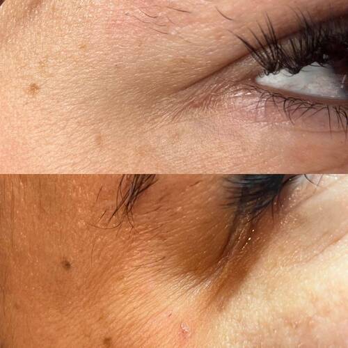 Bottom (Before) & Top (After)