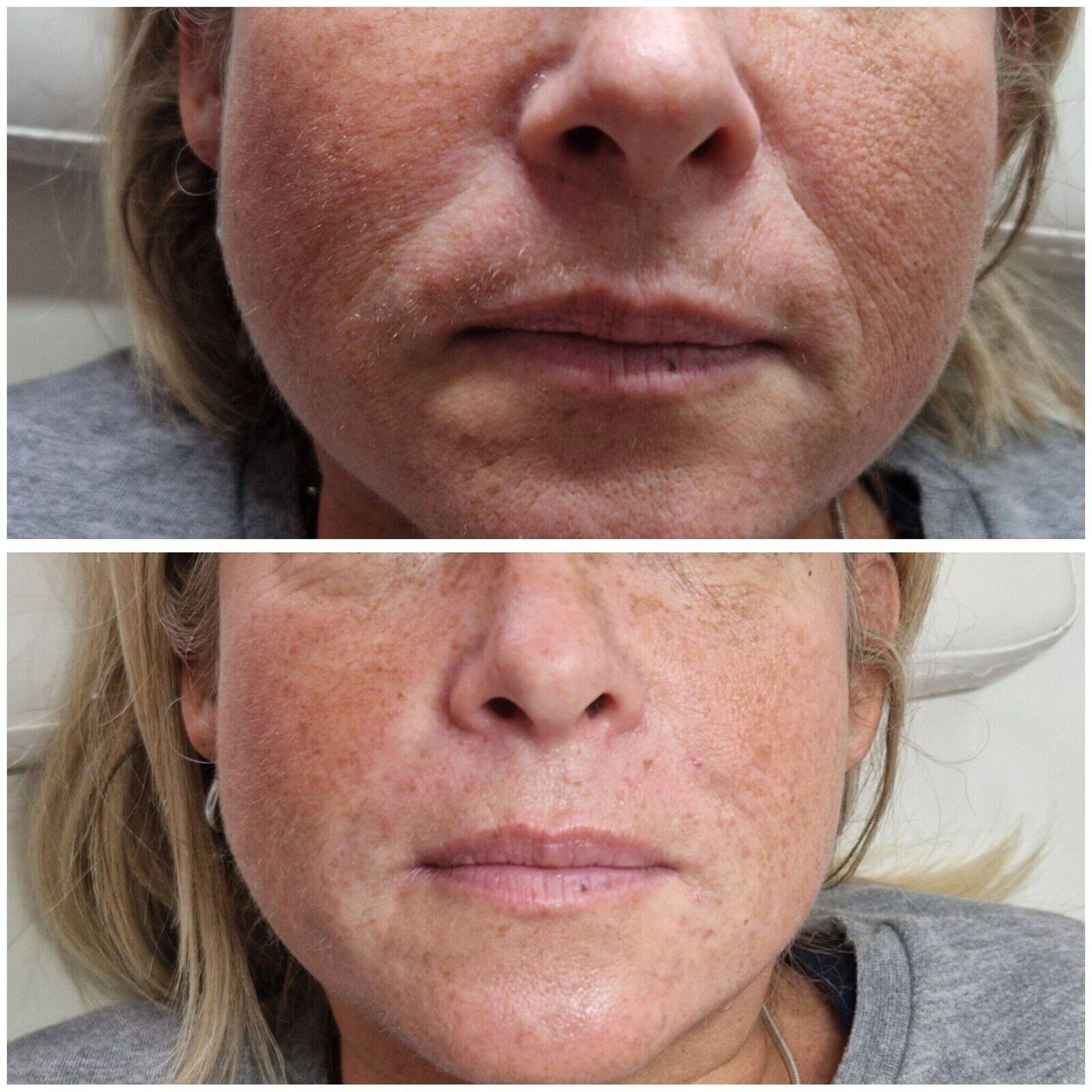 Silent Filler in the Nasolabial folds (nose to mouth)