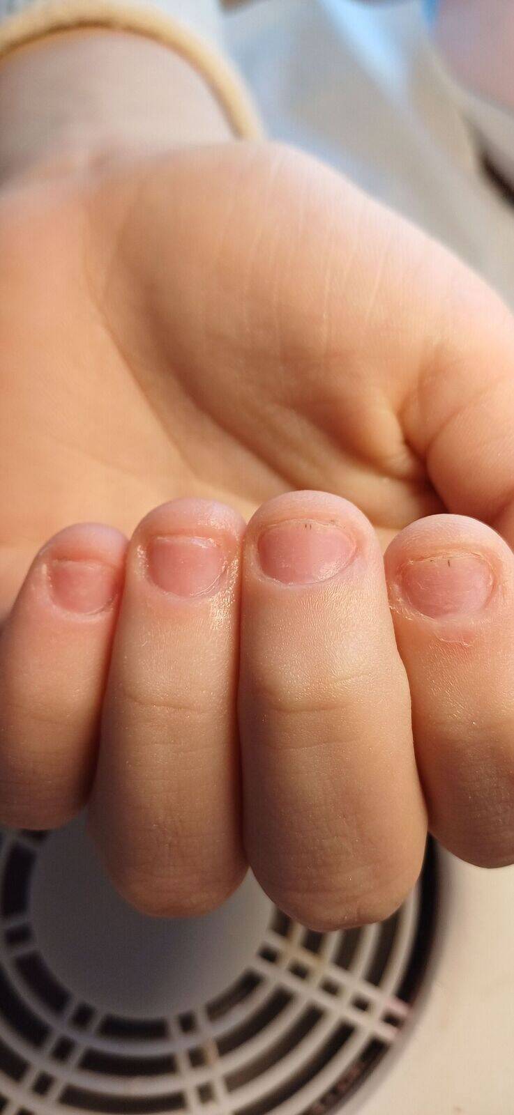 Pose capsule americaine 