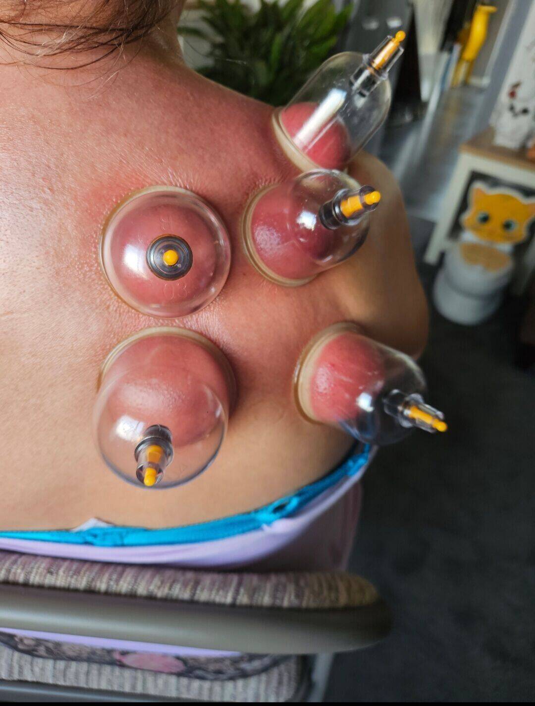 Cupping Therapy
