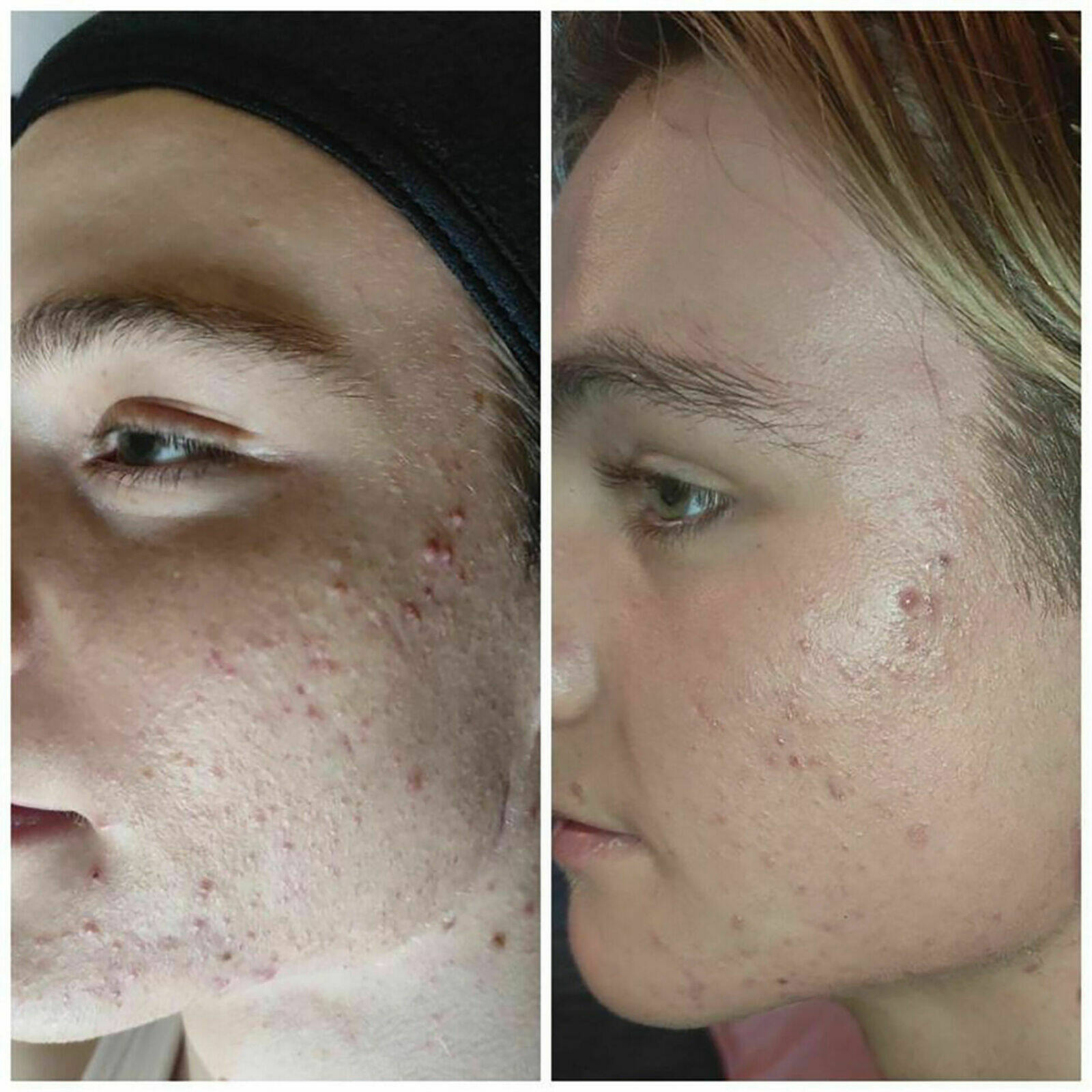 Décaar results are 3 Treatments 