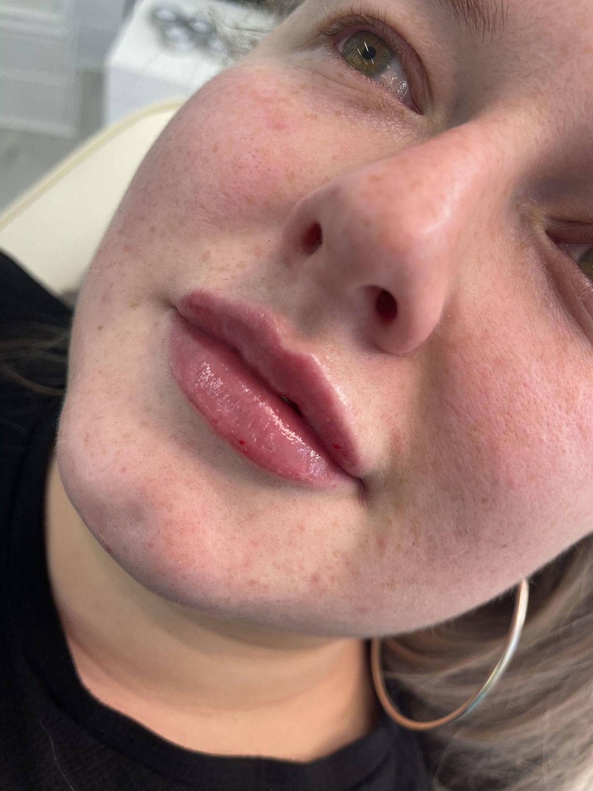 1.1ml Lip Enhancement 
