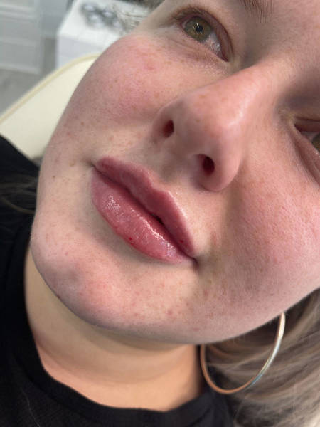 1.1ml Lip Enhancement 