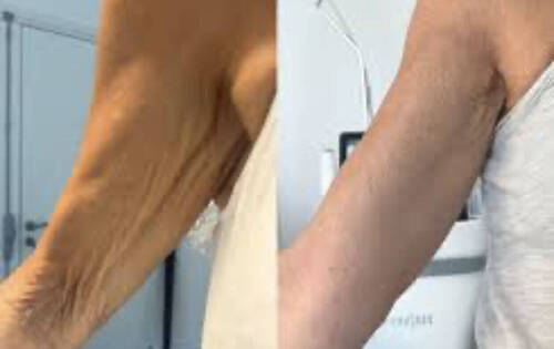 LA RADIOFREQUENCE CORPS - bras 20 min