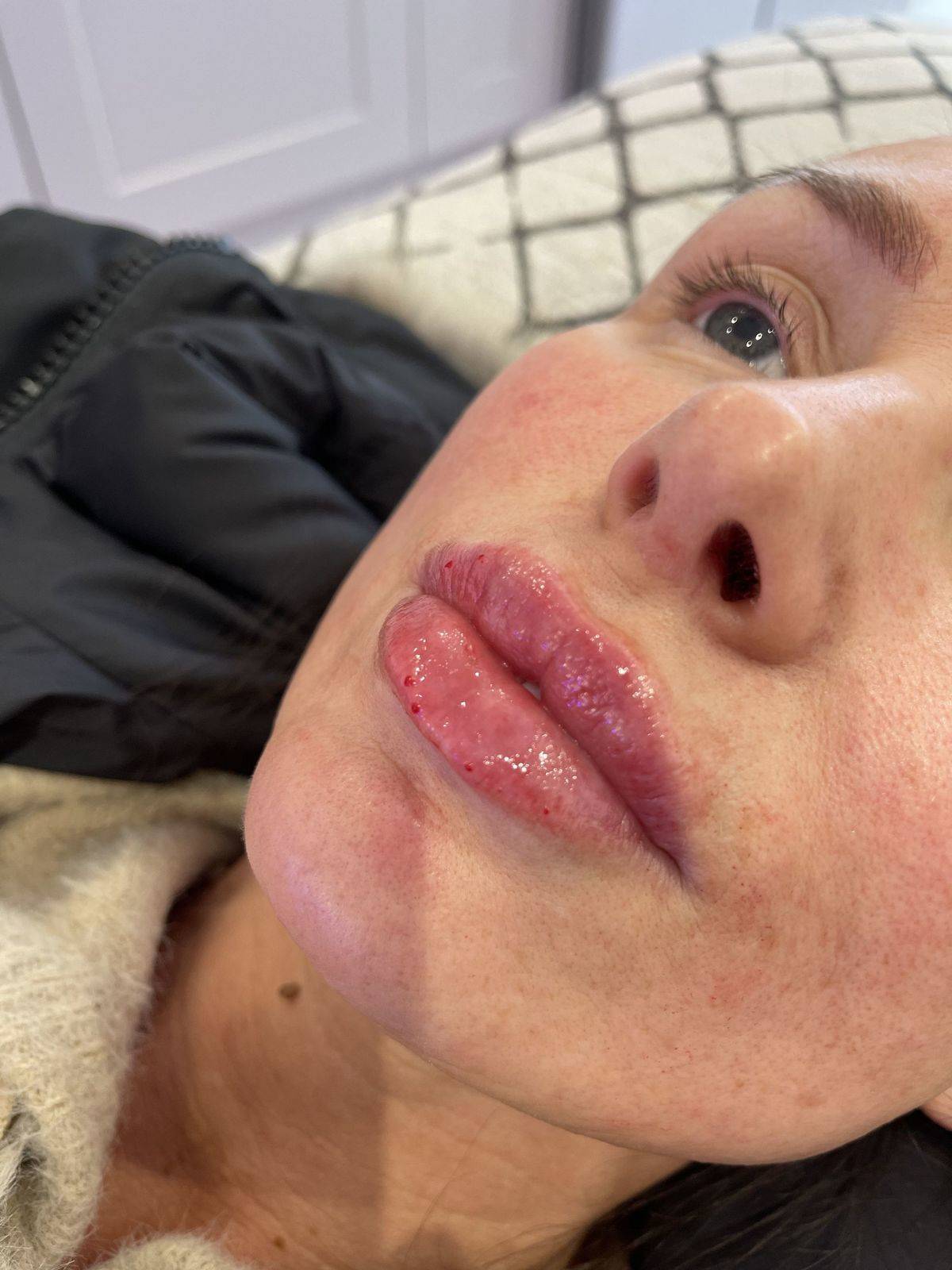 1.1ml Lip Enhancement 