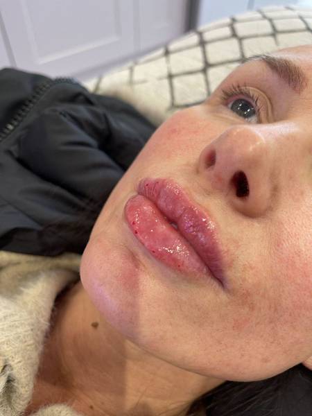 1.1ml Lip Enhancement 