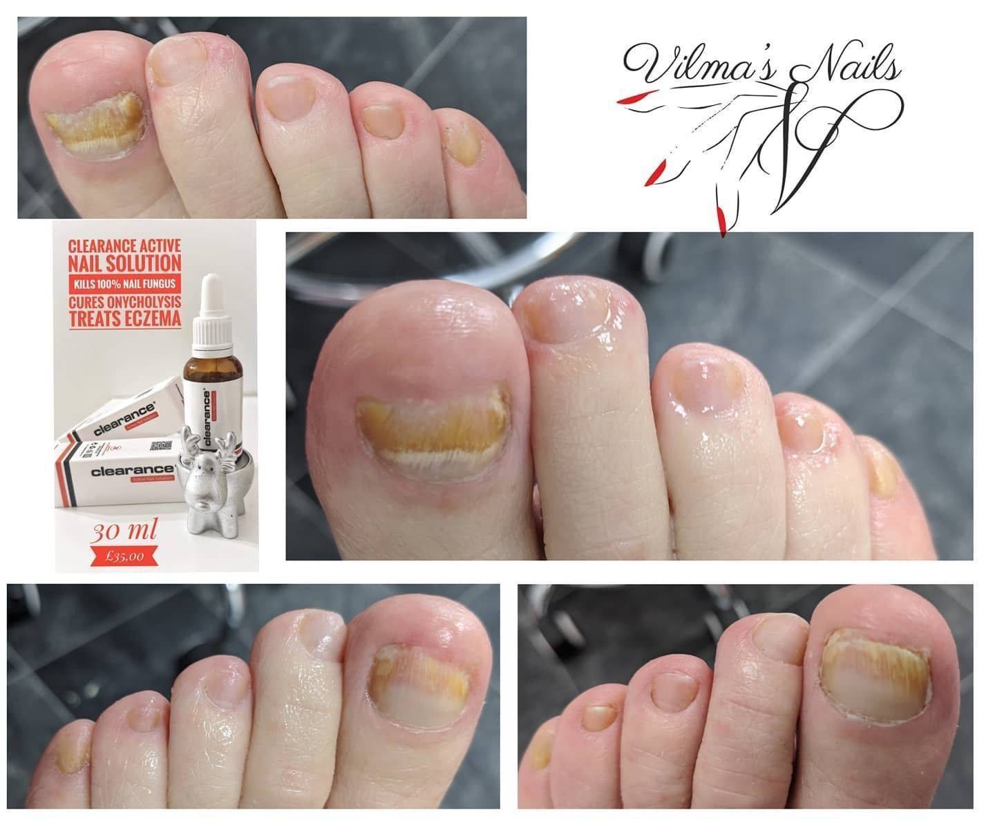 In progress Clearance Solutions drops for Fungal Nail toes