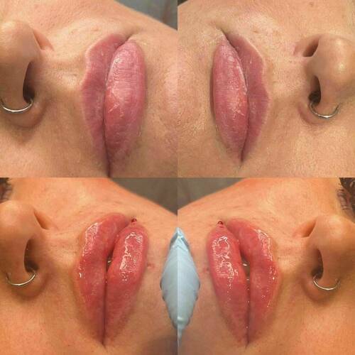 1.1 ml Lip Filler